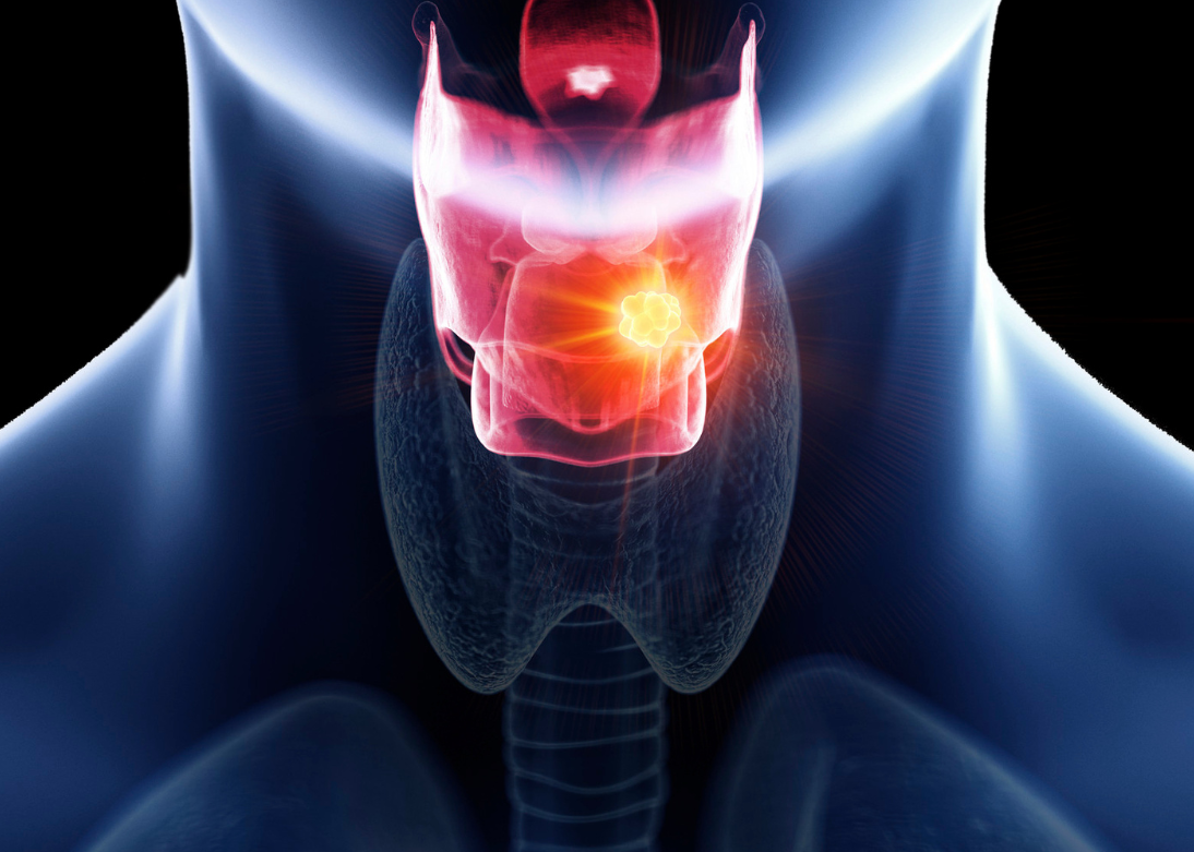 Laryngeal & Pharyngeal Cancer Surgery